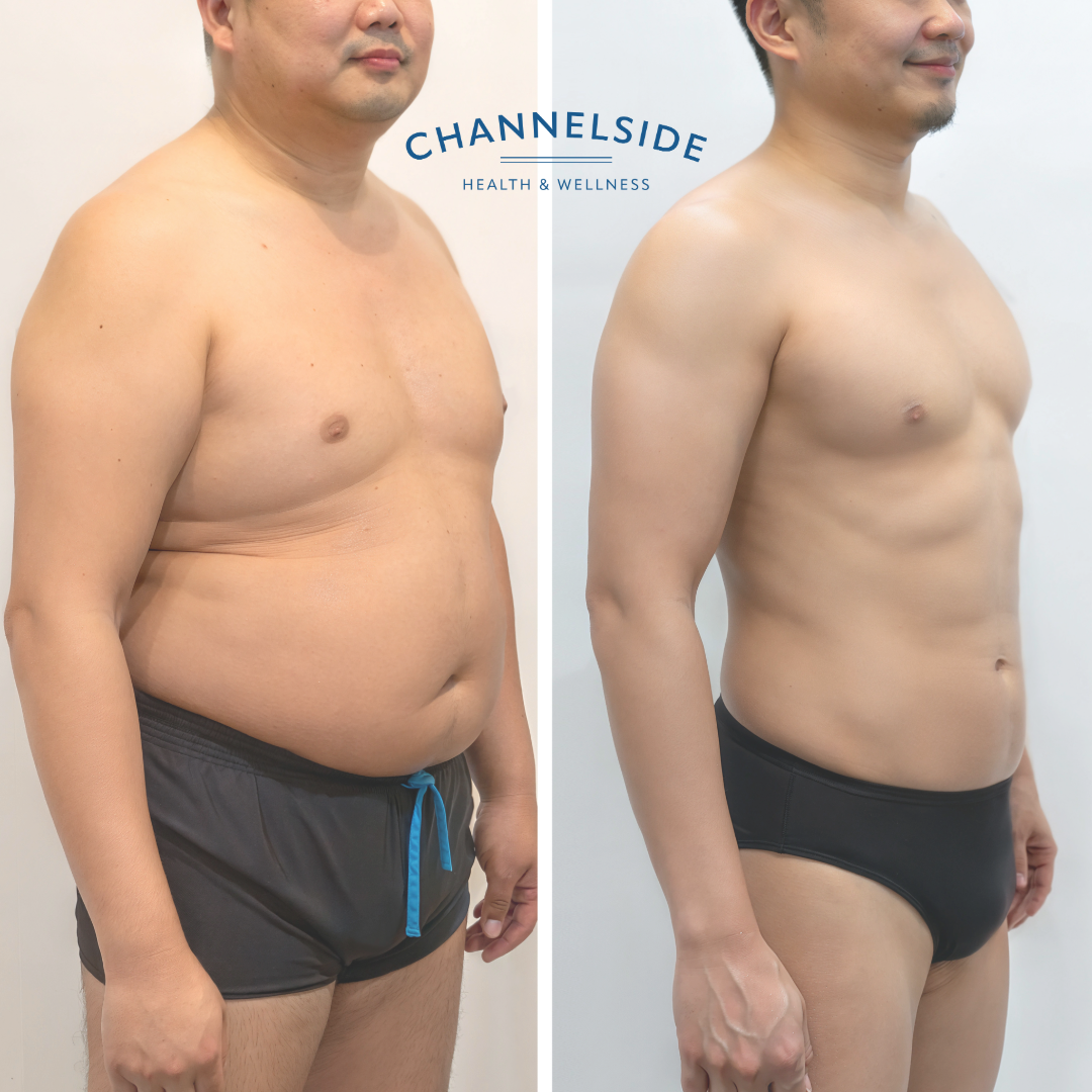 Medical Weight Loss - man with weight loss