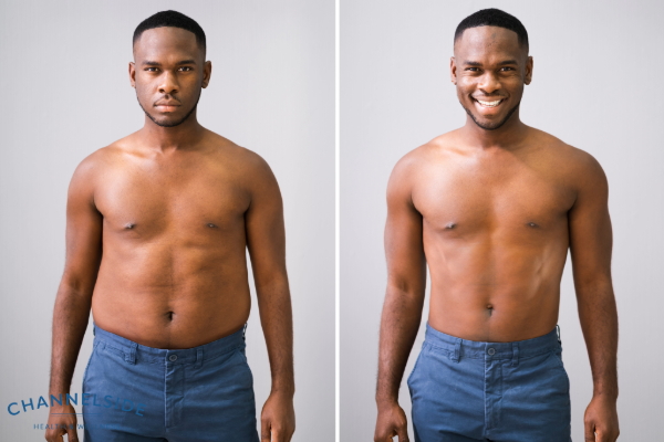  A man losing weight, medical weight loss 